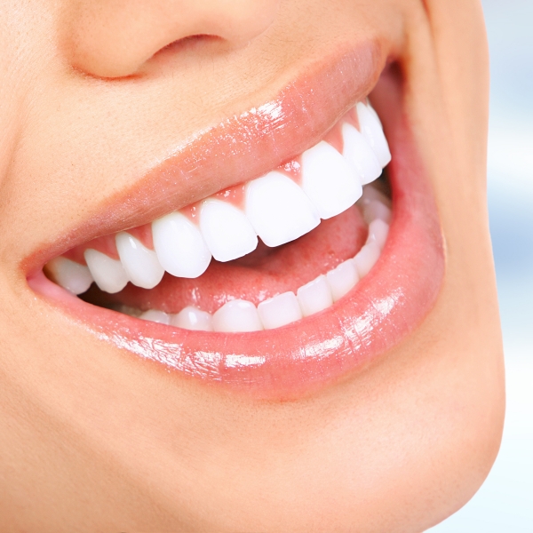Porcelain Veneers